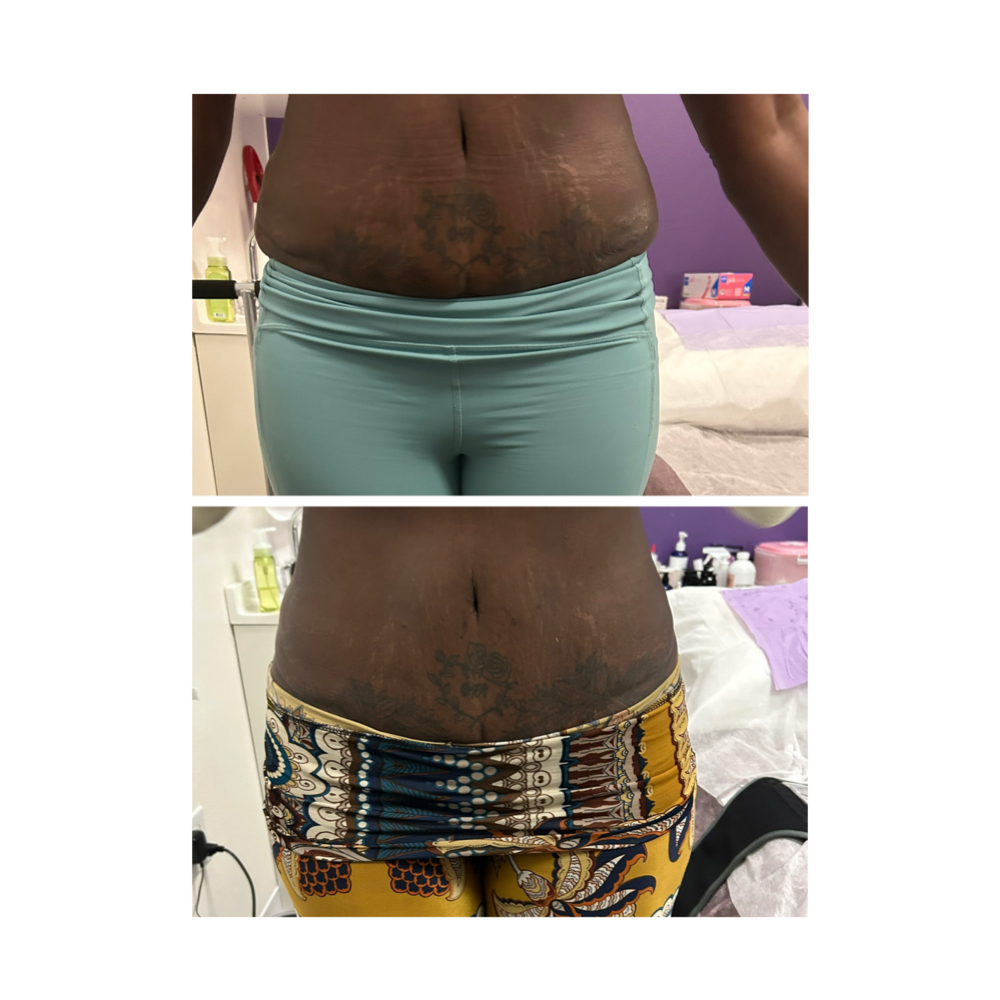 Lipo Upgrade Body Fat Reduction at EnVogue Wellness & IV Solutions in Temecula, CA