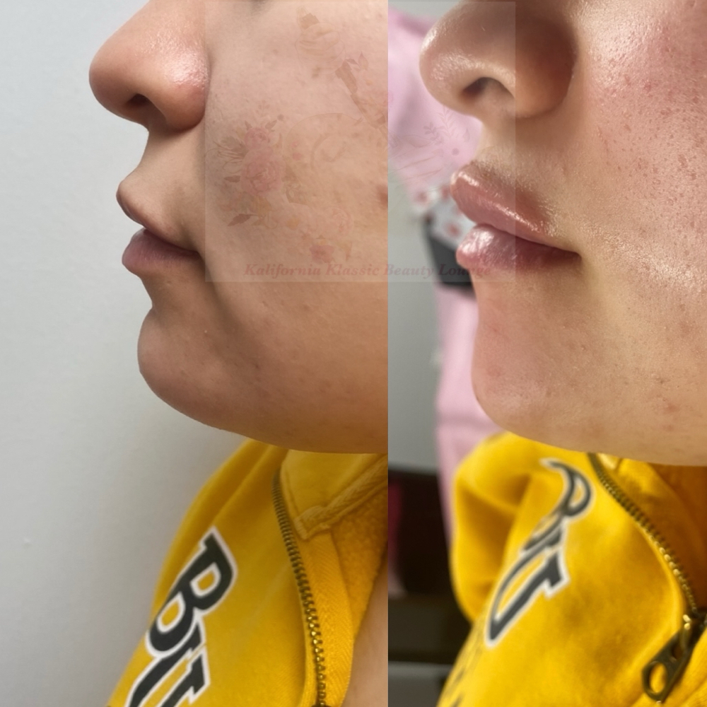 Hya Platinum Chin Augmentation