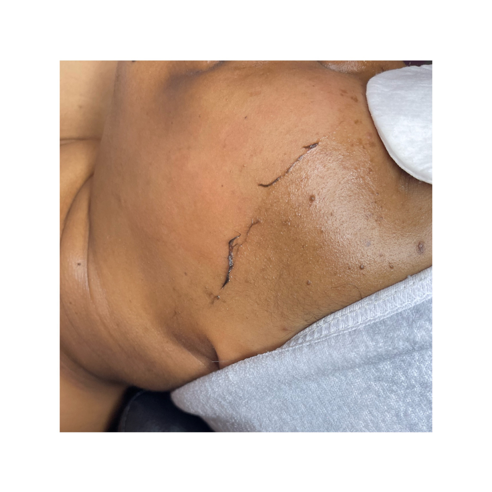 Dermaplane Facial