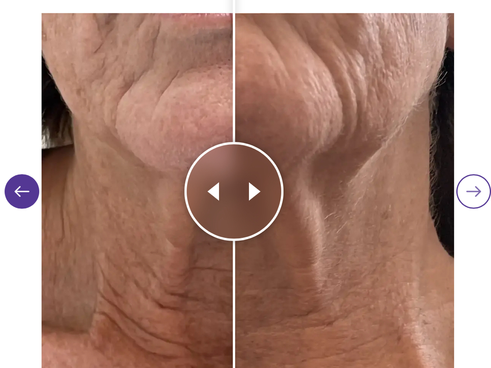 Add on- Procell Neck