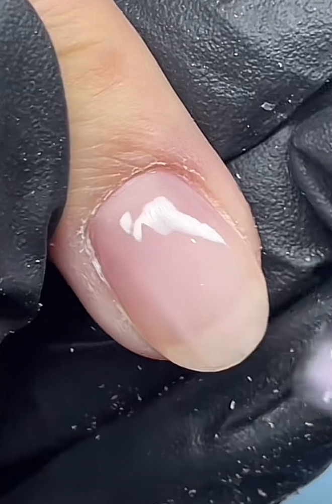 Structured Gel Fill
