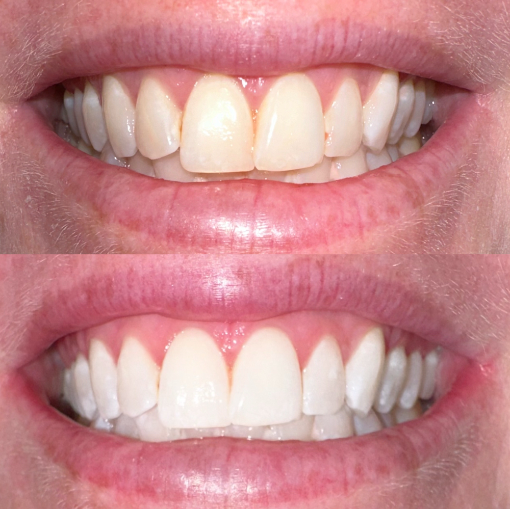 Cosmetic Teeth Whitening