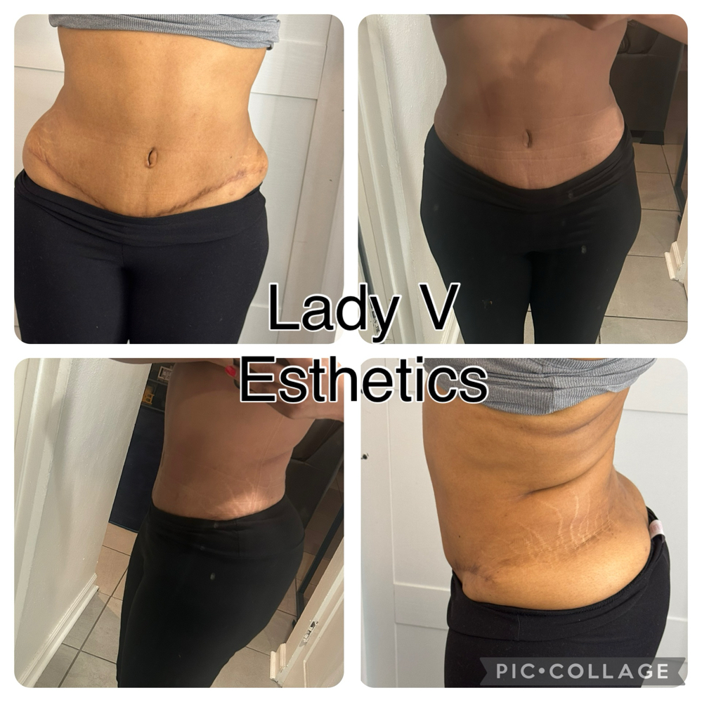 Fat Dissolving Injections 2nd Roud