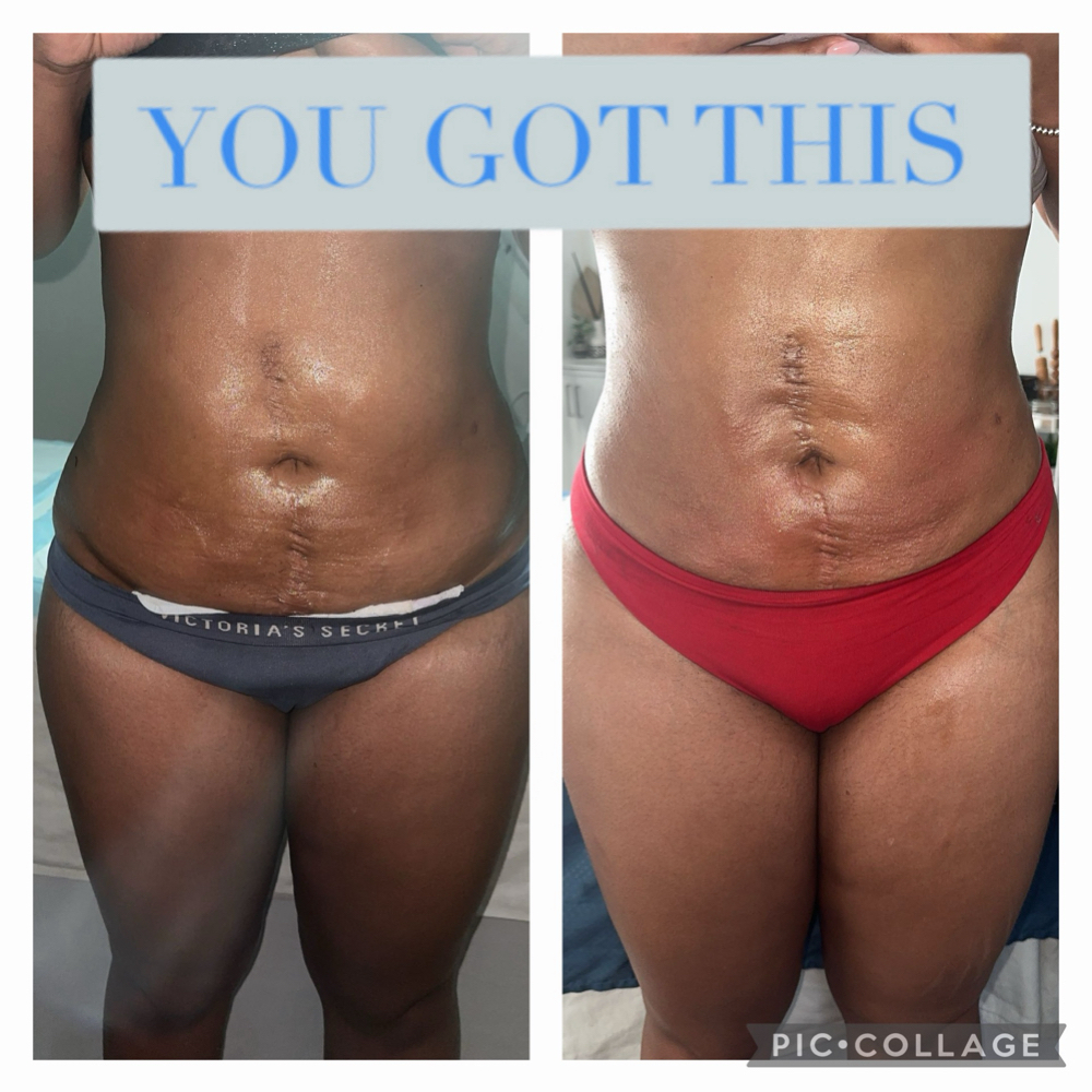 Body Sculpting Bundle at N'Vestd Aesthetics in Fairfeild, OH