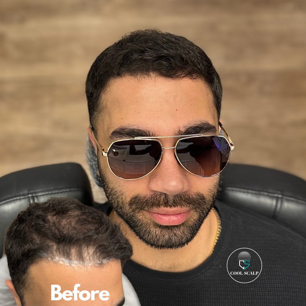 Scalp Micropigmentation Hair Density Enhancement