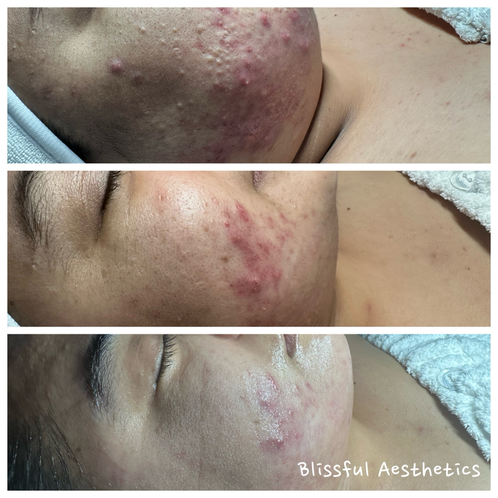 Acne Boot Camp