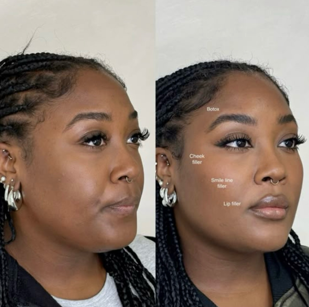 The Total Balance 3 Ml+30 U Of Tox at Balance.Bar.Aesthetics in Berkeley, CA