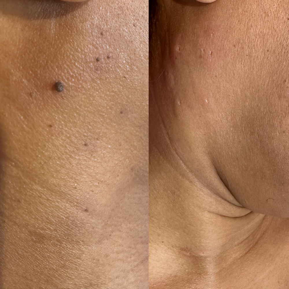 Mole Removal