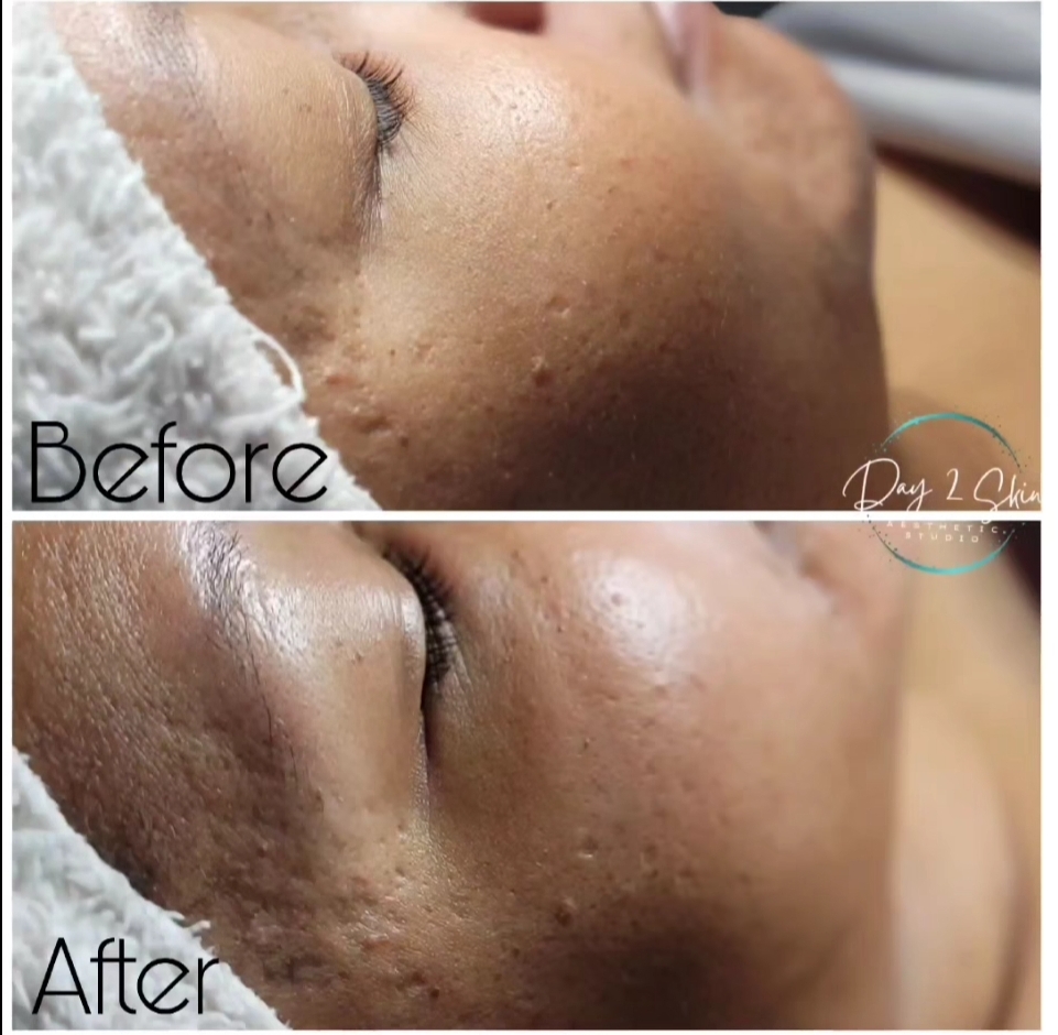 Dermaplaning Express FACIAL