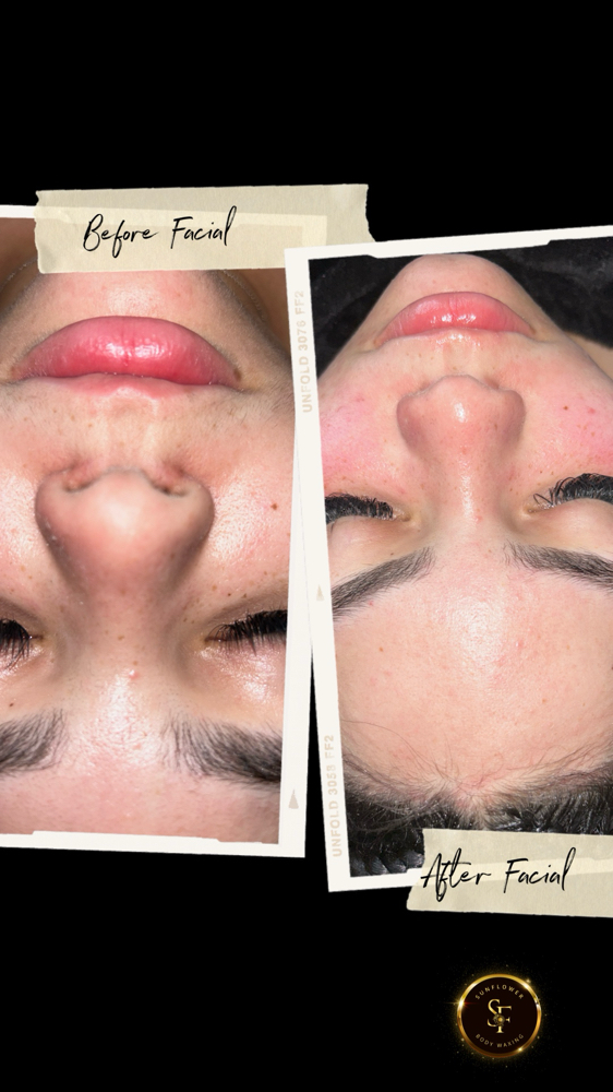 Acneic Facial