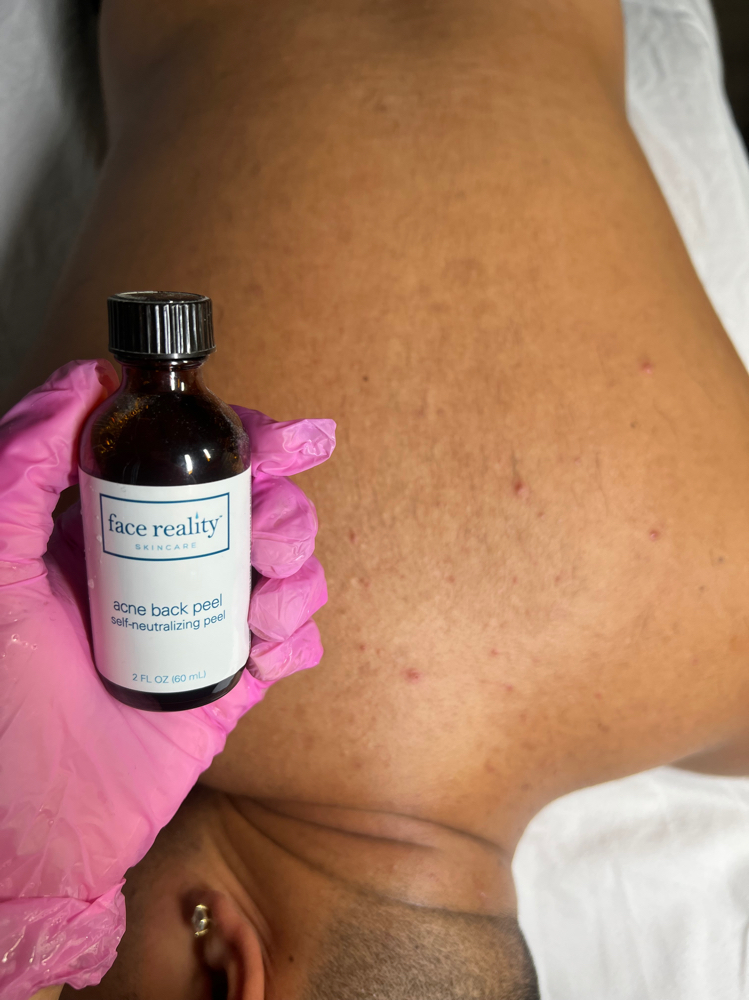 Back Acne Peel