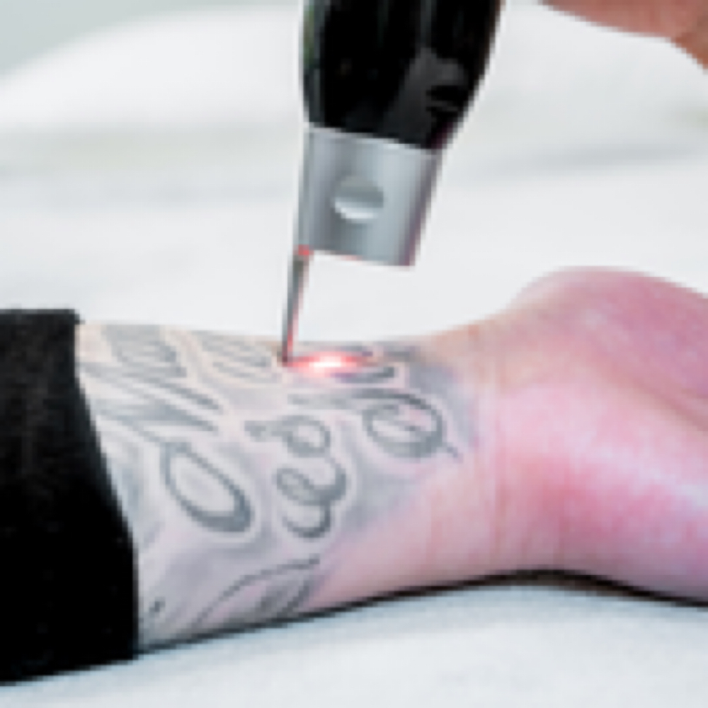 Medium Area (6x6") TATTOO REMOVAL at BEAUTY LAB COLLECTIVE in Miami, FL