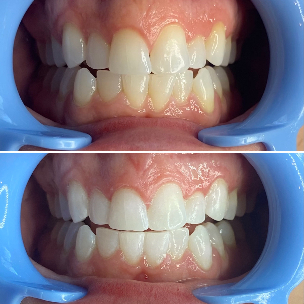 Teeth Whitening