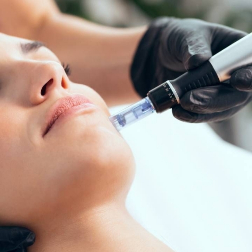 Microneedling With Dermaplane at Cheeky Skin Co. in Lake Stevens, WA