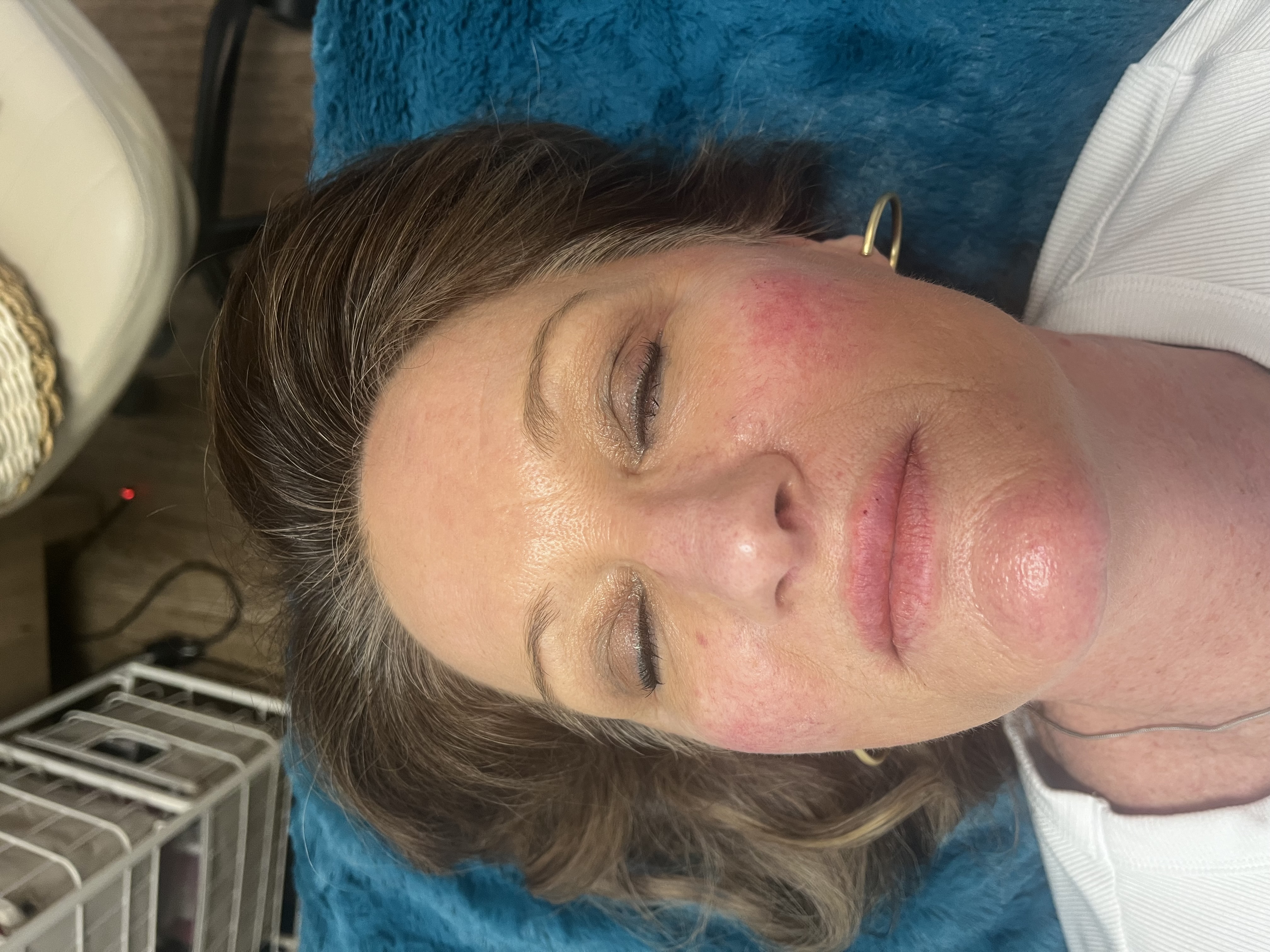 Filler - Half Syringe