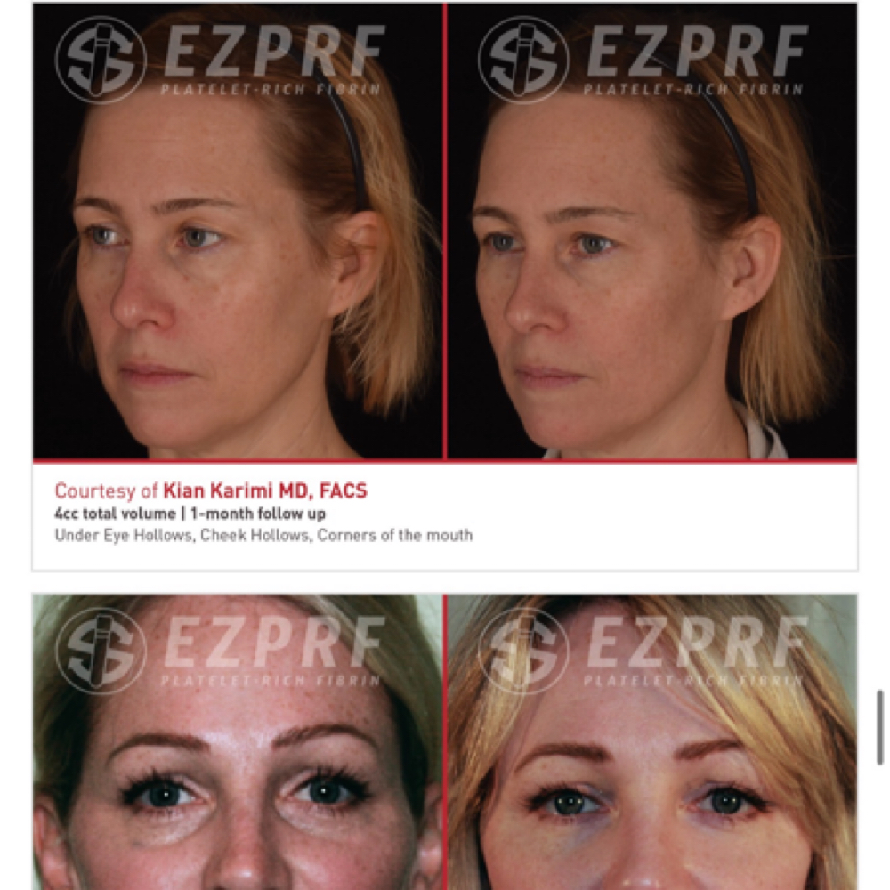 EZGEL-PRP at Beauty Dare Aesthetics PLLC in Laredo, TX