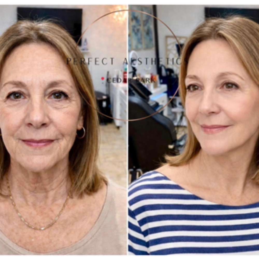 đ§Sculptra Biostimulator $550 at Perfect Aesthetics - Browse treatments,view pricing, book online 24/7 in Cedar Park, TX