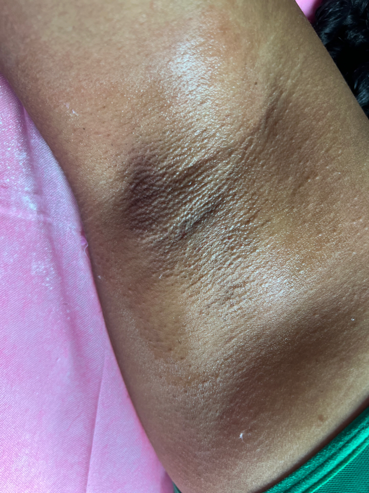 underarms