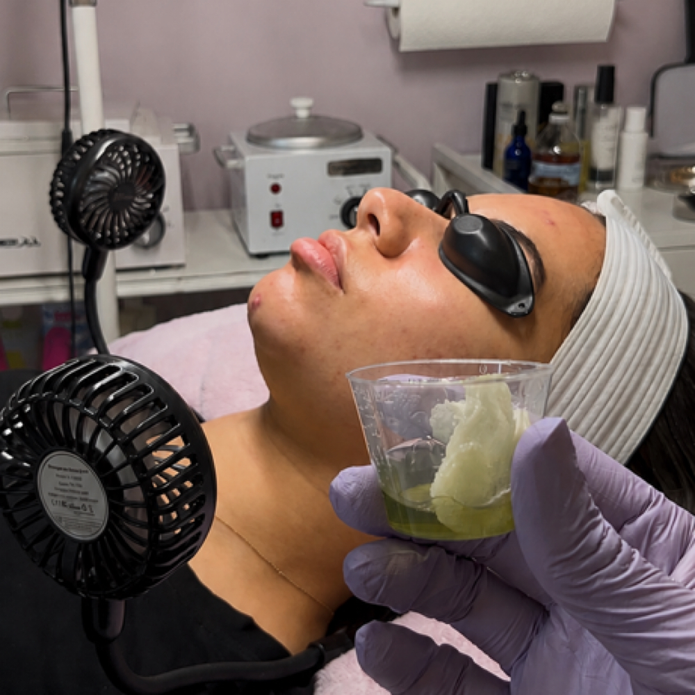 Professional Peel at Desthetics Beauty in Bronx, NY