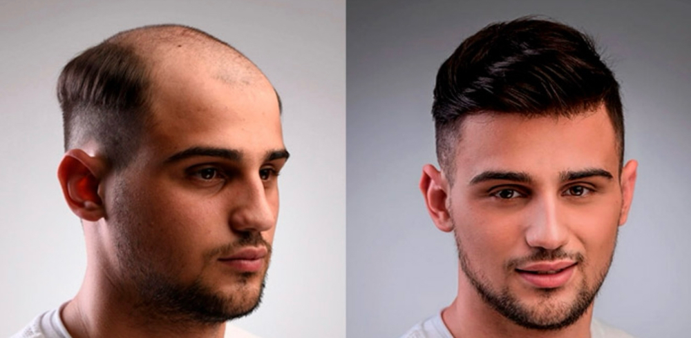 Mens Hair Replacement Syst Consult