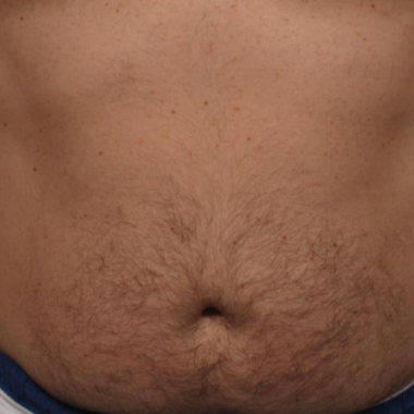 Stomach Laser Hair Removal at The Beautee Spot in Phoenix, AZ