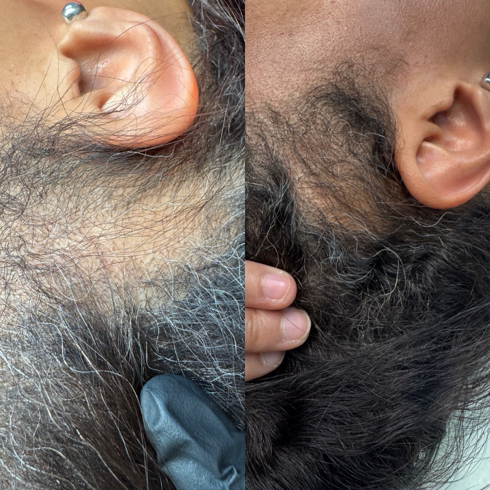 CAPILLAR Treatment