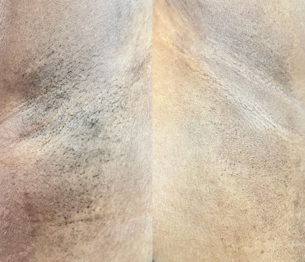 Arm Pit Wax at ๐ข๐ฑ๐ฎ๐๐ต๐ฒ๐ท๐๐ in Charlotte, NC