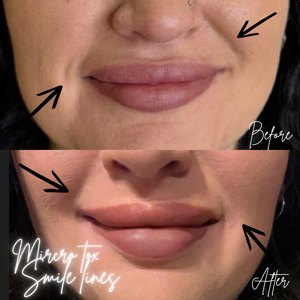 Tox-Micro Tox Smile Lines💉 at BeautyHolic Aesthetics LLC in Lubbock, TX