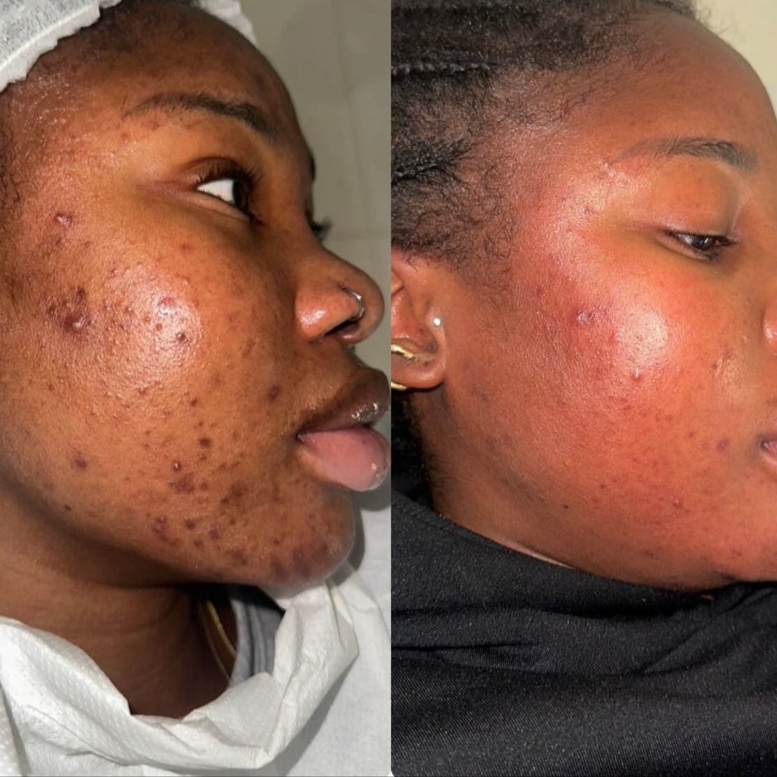 Organo Herbal Peel (Face) at Velnaira in Lakewood, CA