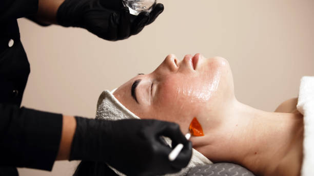 Chemical Peel Facial