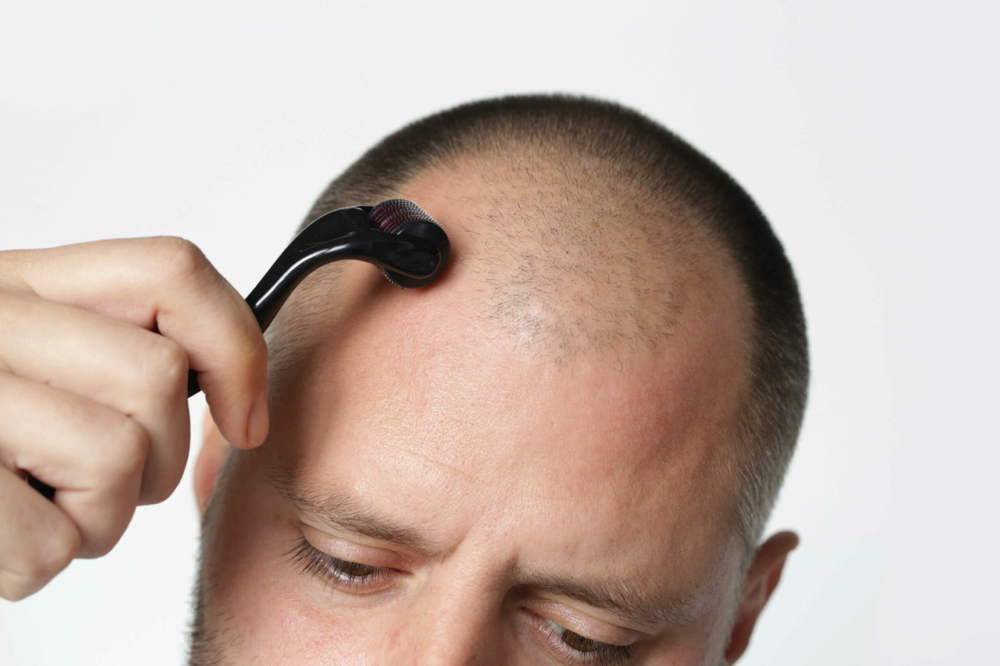 Hair Restorarion (Micro-Needling)