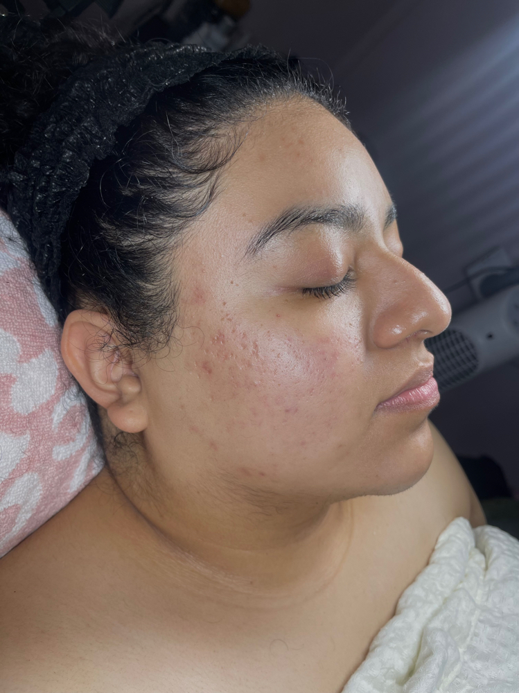 acne facial
