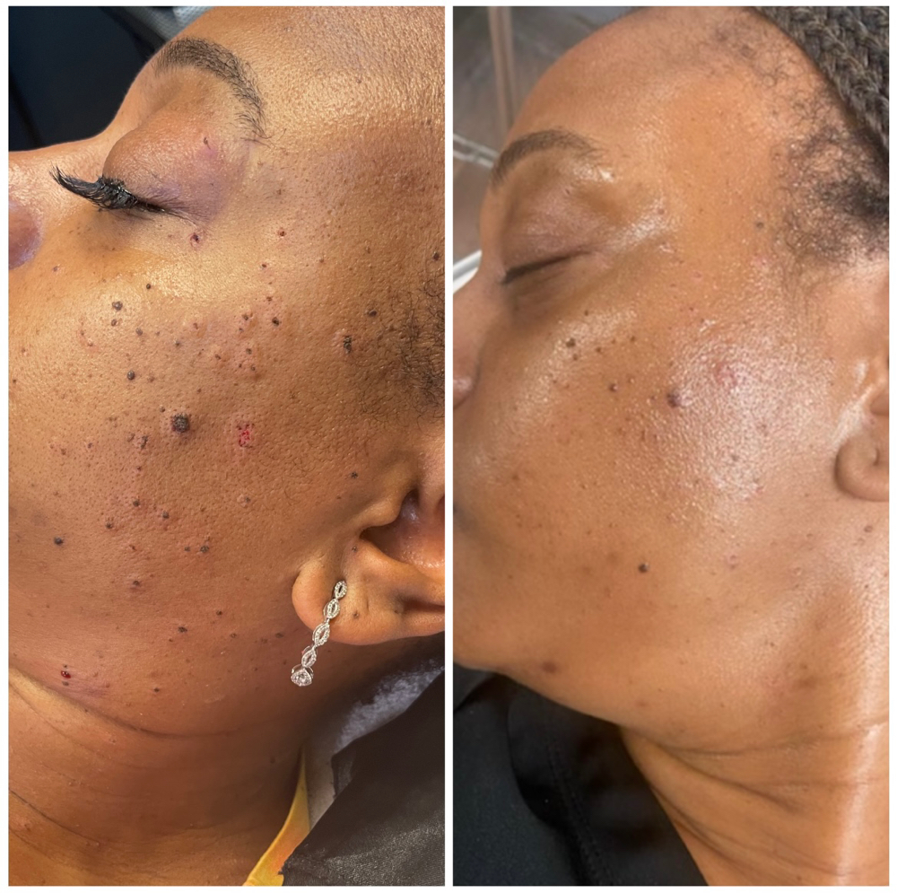 DPN Skin Tag Removal 6-10