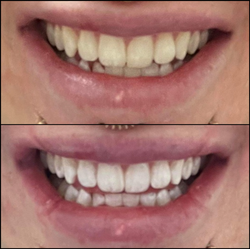 Teeth Whitening
