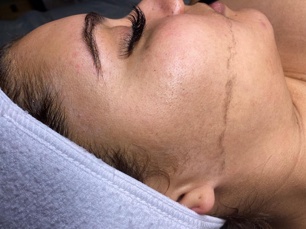 Radiant Dermaplaning Facial