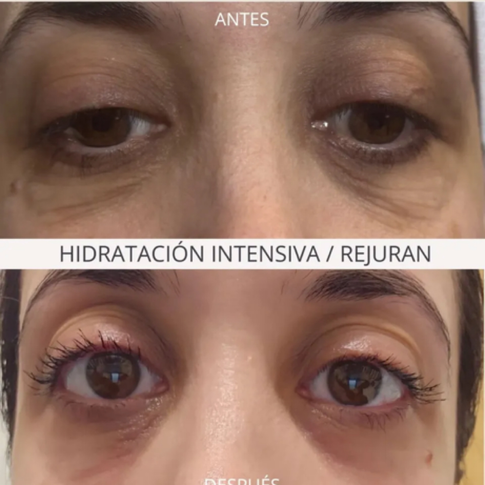 Microneedling /PDRN ( Salmon DNA) at Mily Aesthetics in Newark, NJ