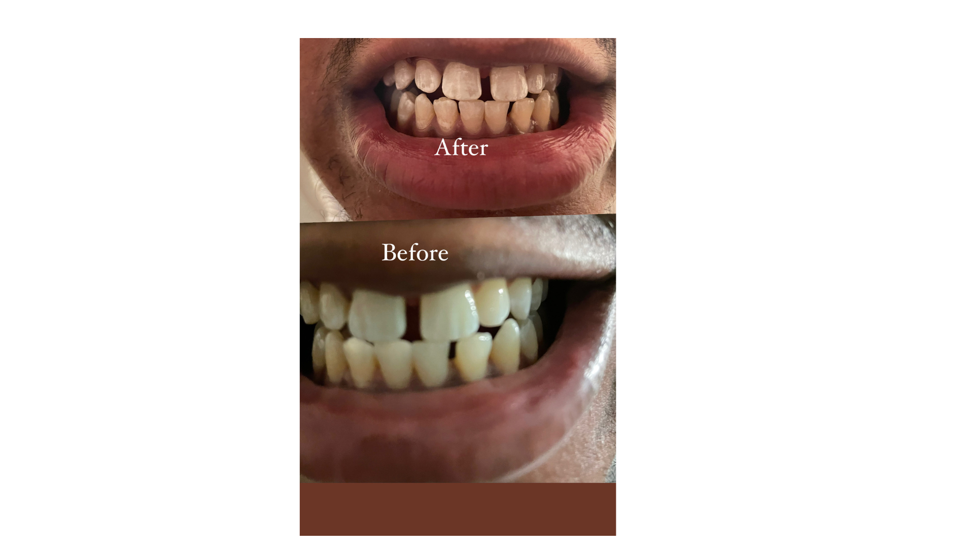 3 Sessions 90m Teeth Whitening