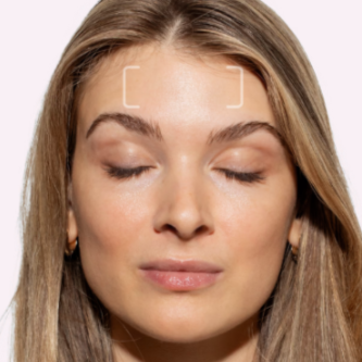 Forehead Tox at Injections by Leighanna in Clarksville, IN