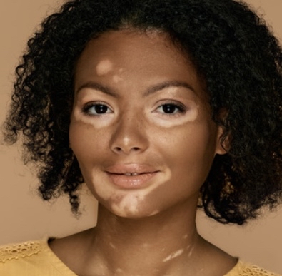 Vitiligo Camouflage