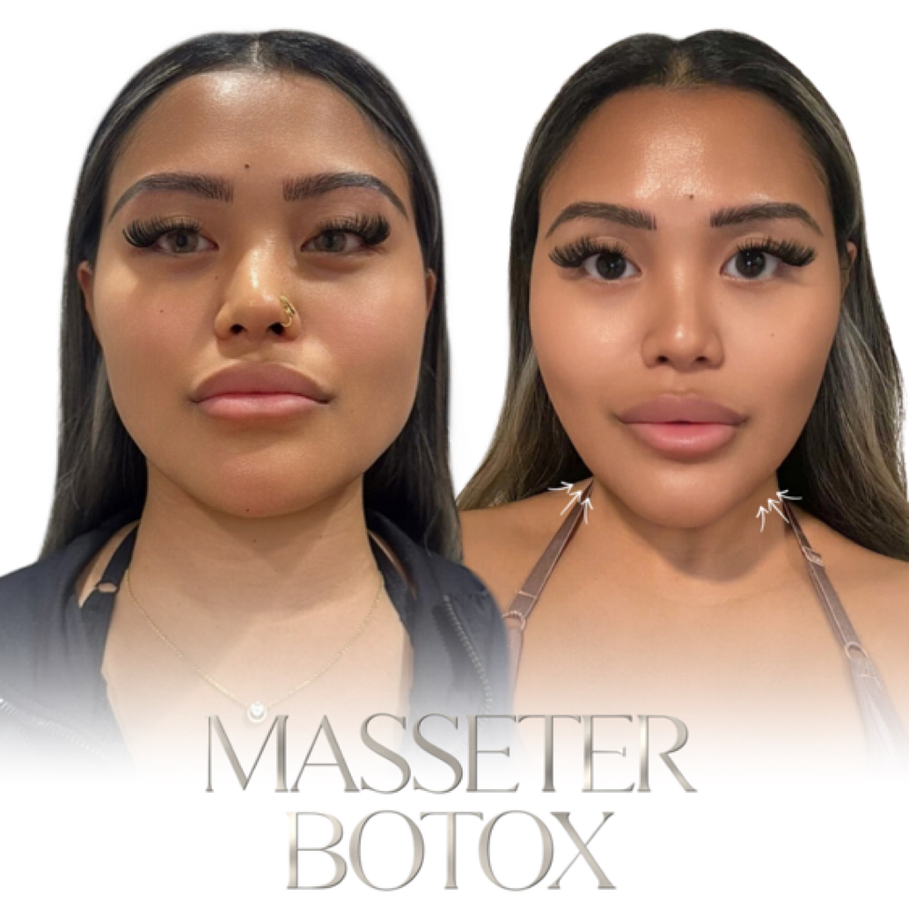 Masseter Tox at Magnetic Aesthetics in Frisco, TX