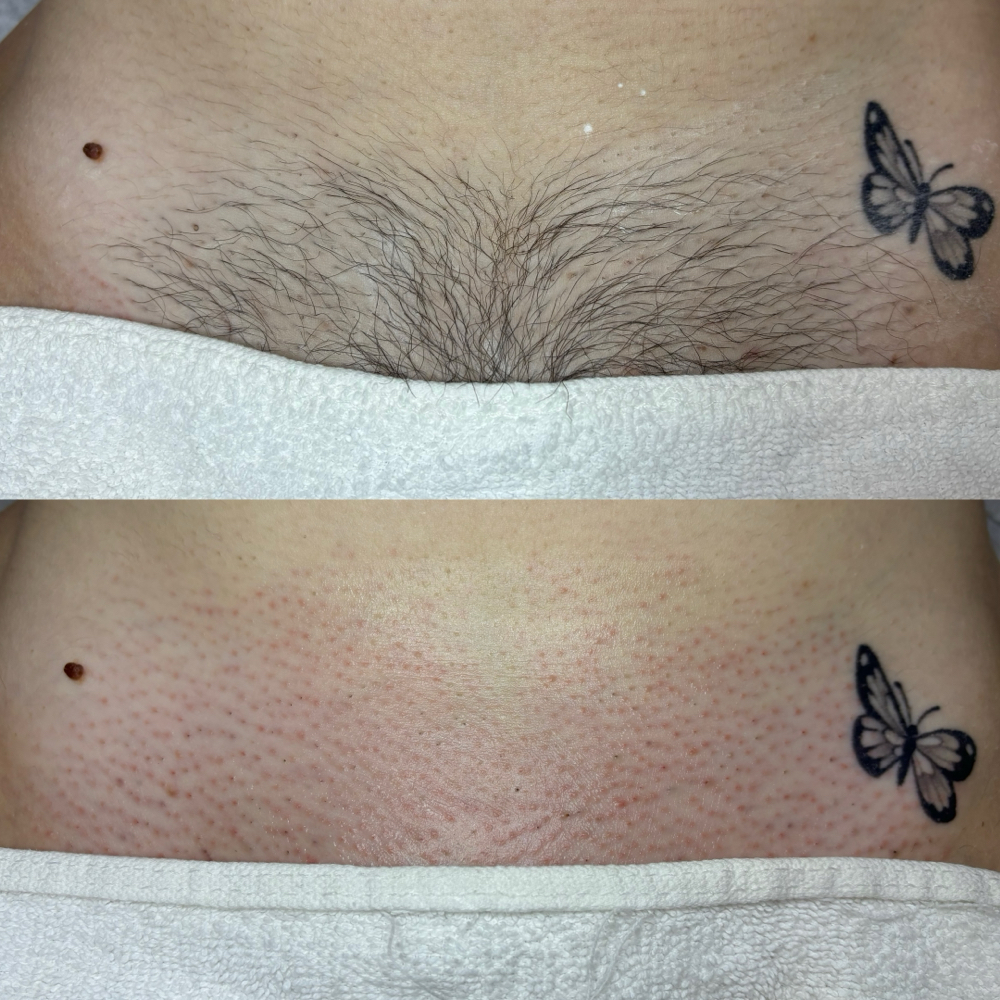 Brazilian Wax
