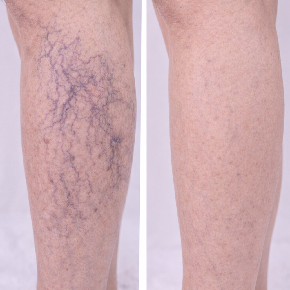 Vein Removal  - Large Area