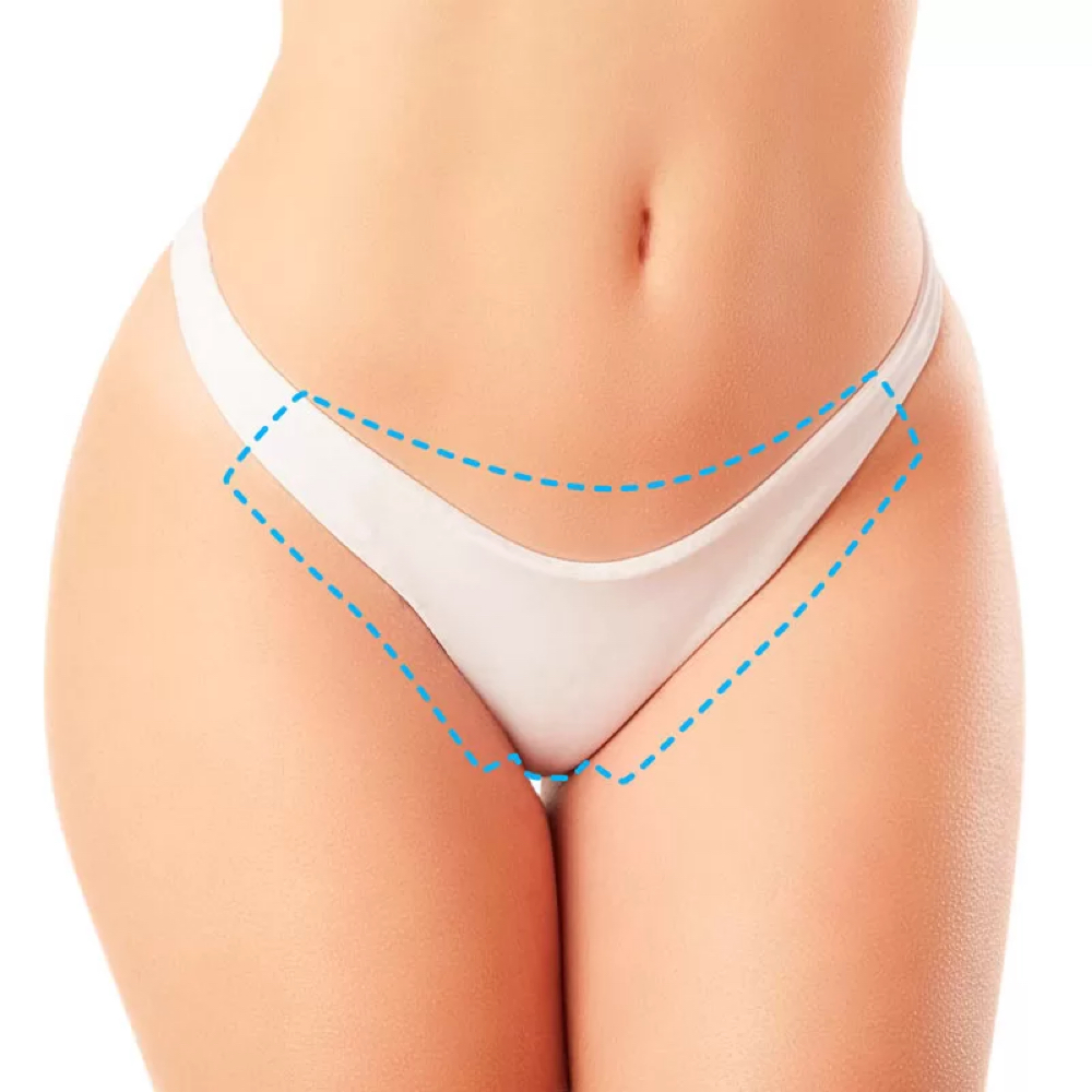 Diodo Laser (Bikini) at Diana Bella LLC in Deerfield Beach, FL