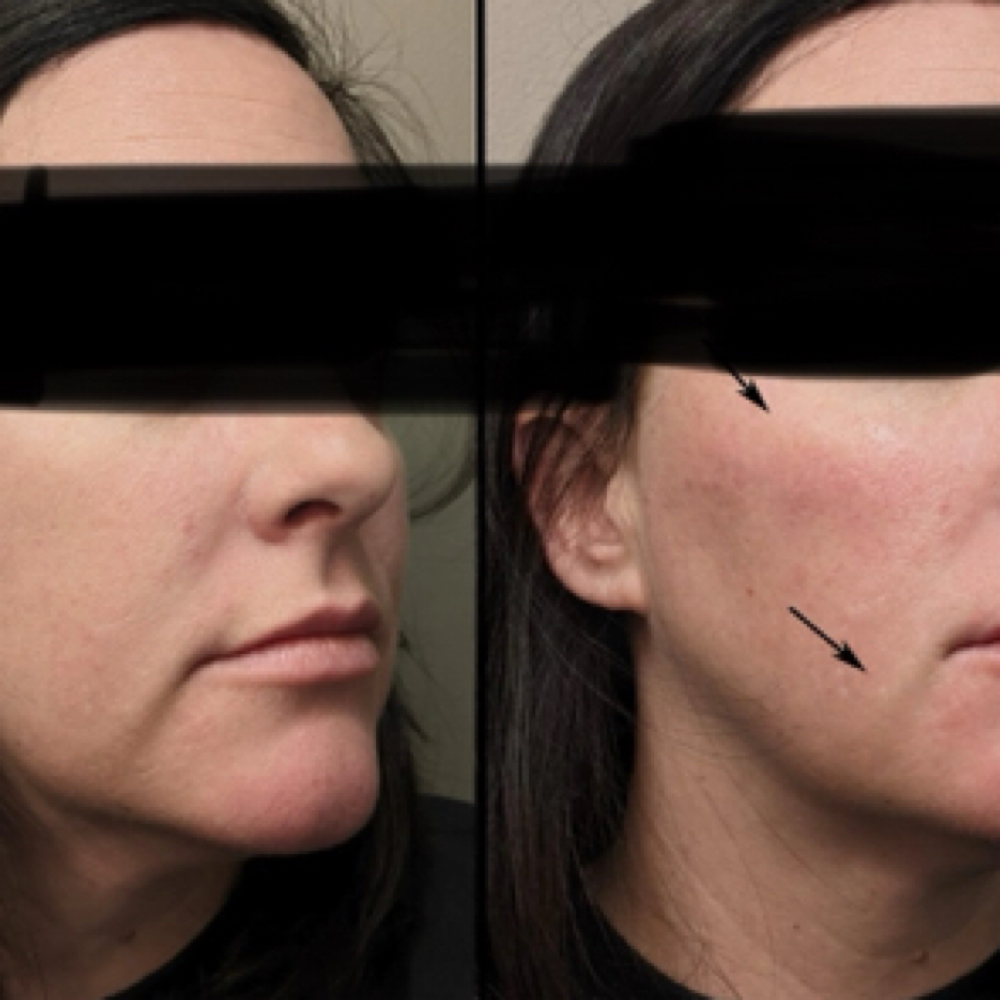 Botox- Marionette Lines at Groomsology MedSpa in Mt Orab, OH