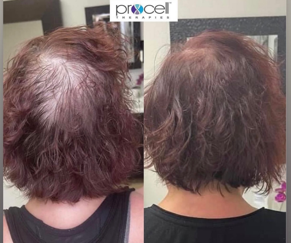 MICROGLOW HAIR GROWTH