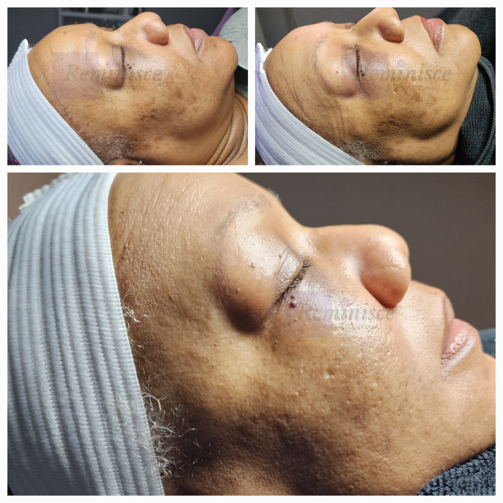 Microneedling + (Most Effective)