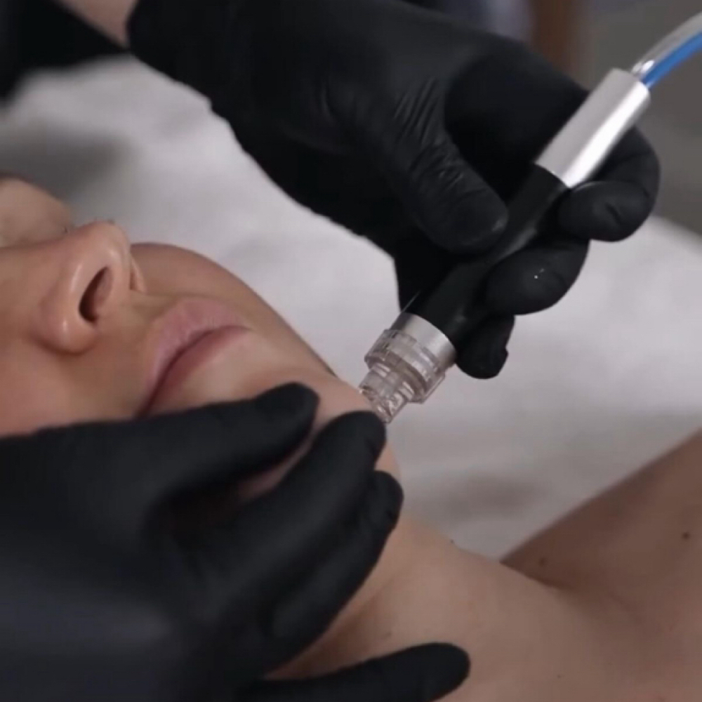 Mini Hydro-derm Facial at Everé Head Spa in Duncanville, TX