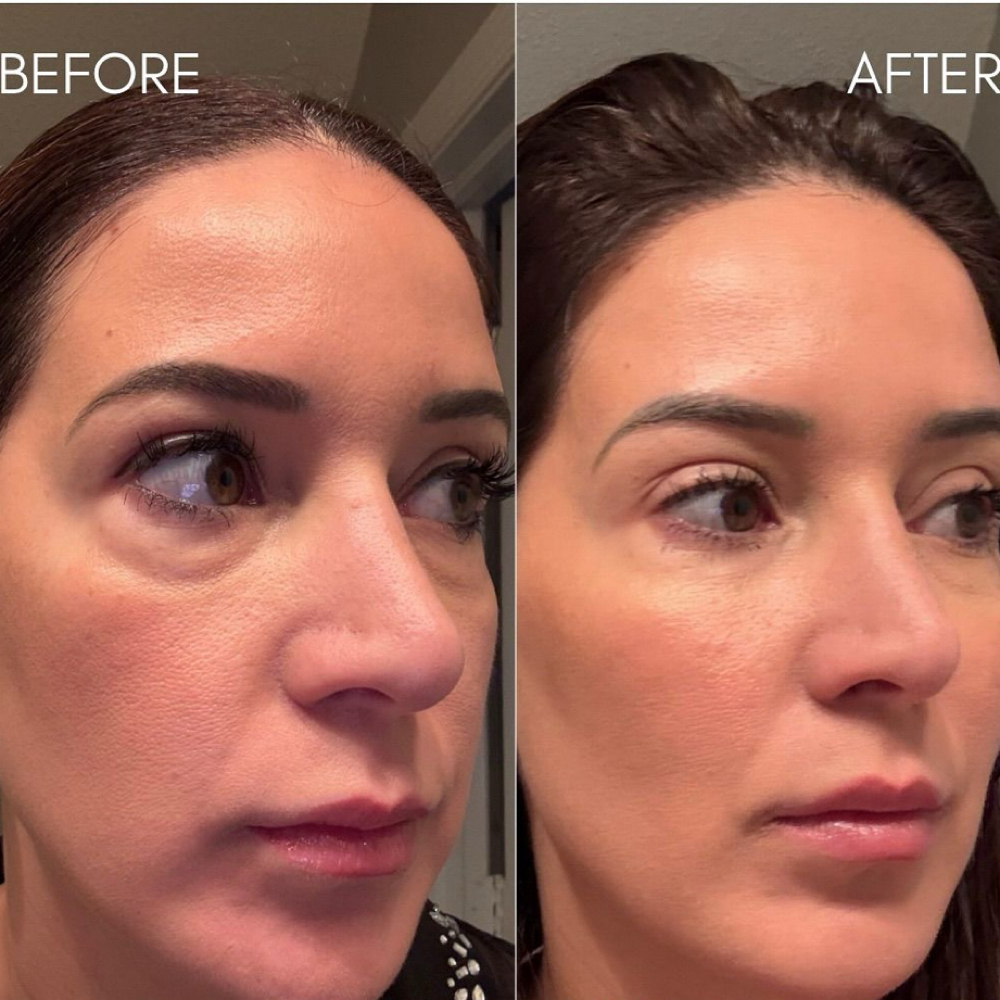 Under Eye Filler at La Belle Aesthetics & Wellness in Hellertown, PA
