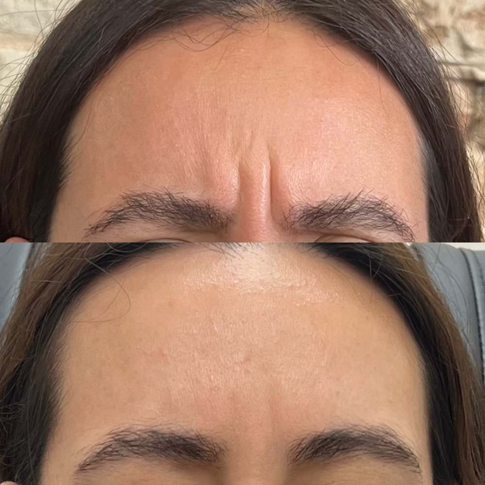 Botox - Glabella (11 Lines)