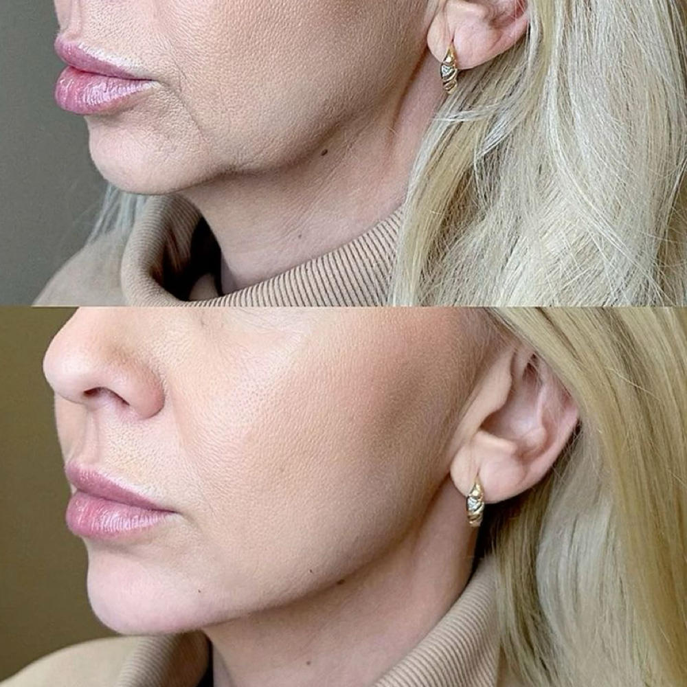 Jowls at Lilli Aesthetics LLC in Mansfield, TX